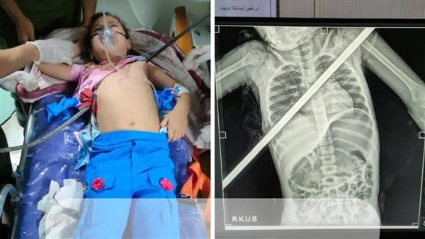 فريق طبي بمستشفيات بنها الجامعية ينقذ طفلة بعد اختراق صدرها سيخ حديدي