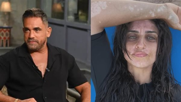 نسرين كرارة تعلن إصابتها بالبهاق.. وشقيقها يدعمها: مفيش في حلاوتك
