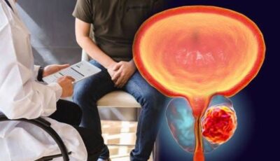 هل تضخم البروستاتا يمنع الإنجاب؟ استشاري مسالك يوضح
